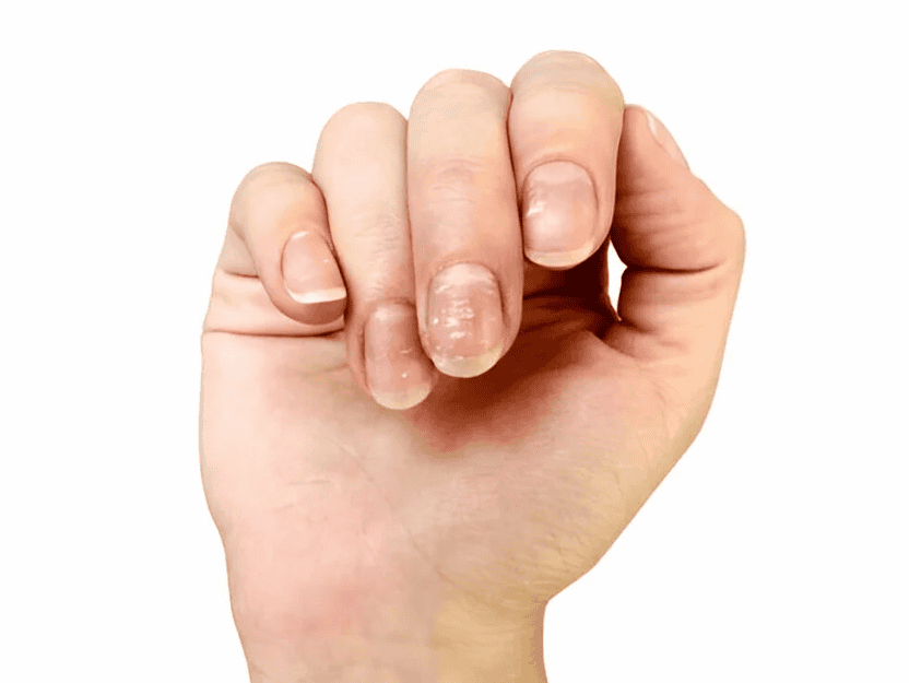 Calcium deficiency